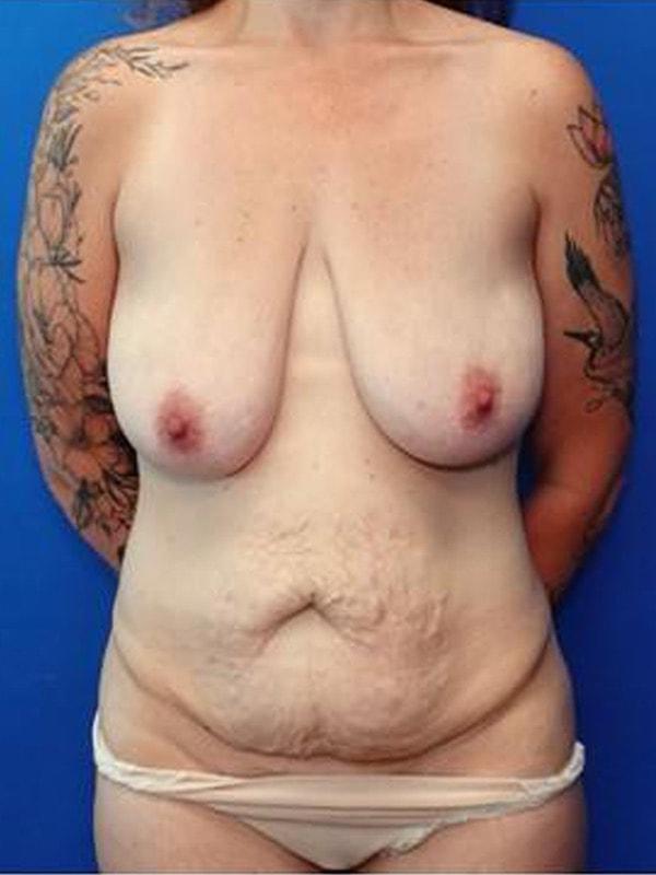 Mommy Makeover before at Said Plastic Surgery in Seattle, WA