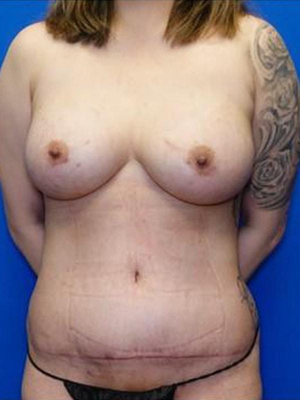 Mommy Makeover after at Said Plastic Surgery in Seattle, WA