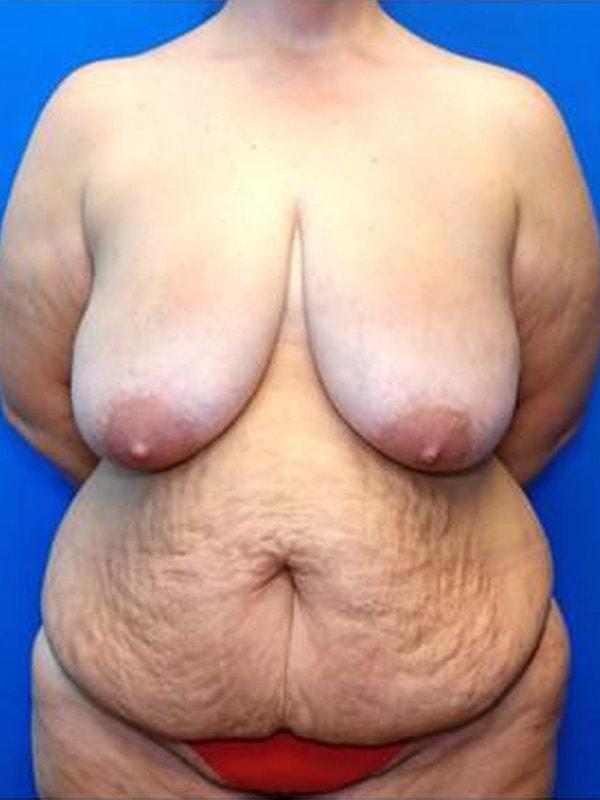 Mommy Makeover before at Said Plastic Surgery in Seattle, WA