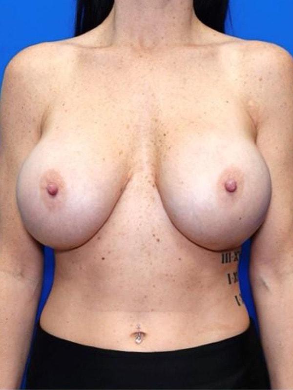 Said Plastic Surgery breast augmentation revision after — Seattle, WA