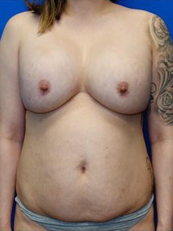 Mommy Makeover before at Said Plastic Surgery in Seattle, WA