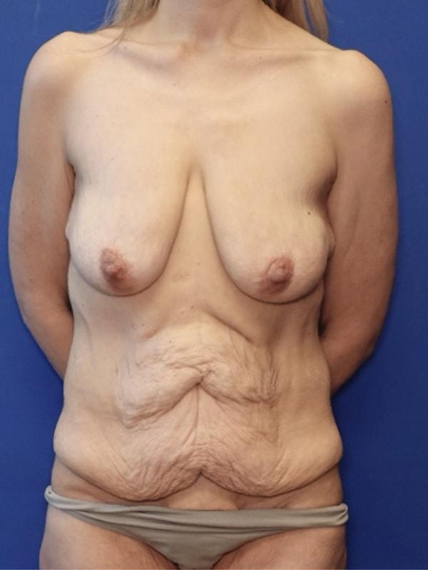 Mommy Makeover before at Said Plastic Surgery in Seattle, WA