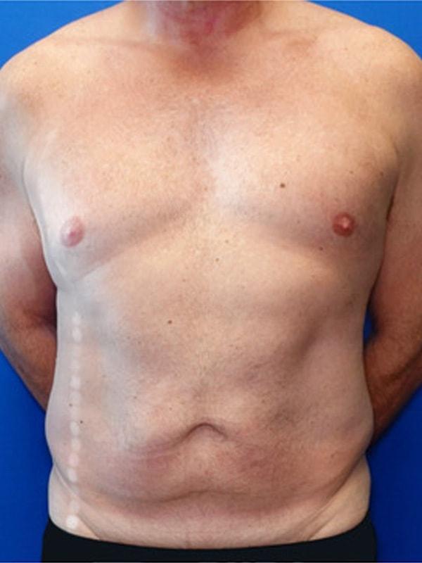 Liposuction before at Said Plastic Surgery in Seattle, WA