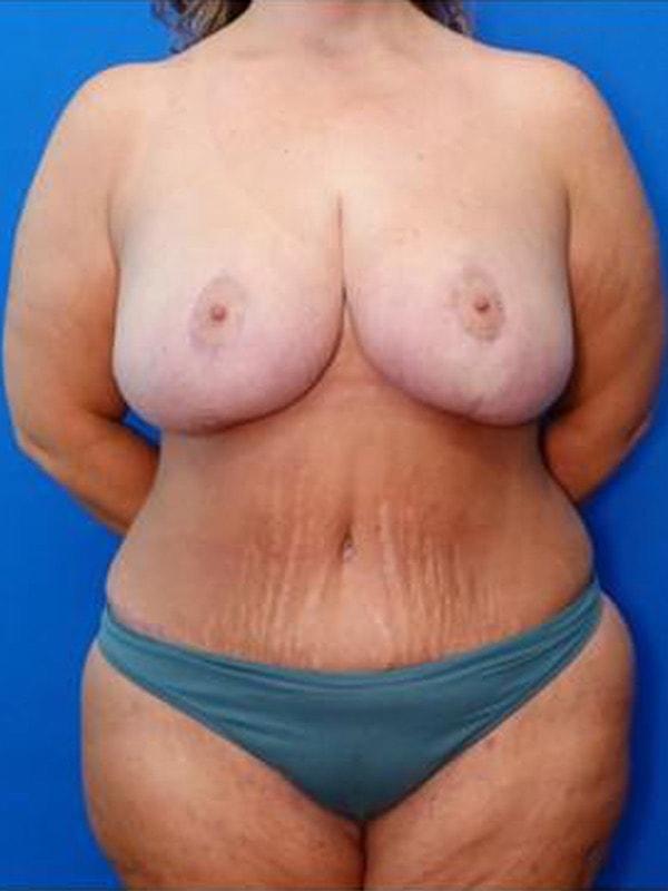Mommy Makeover after at Said Plastic Surgery in Seattle, WA