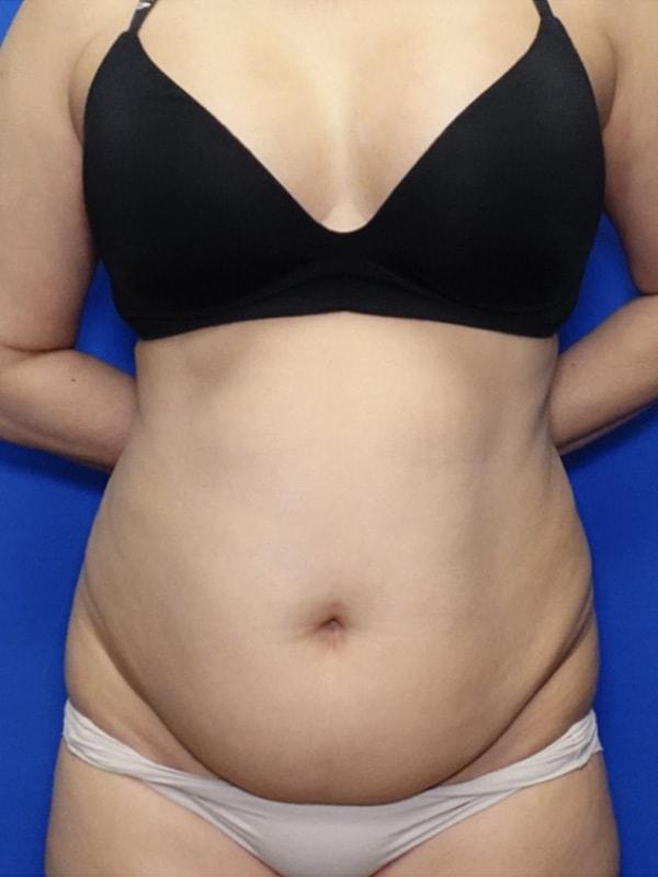 Mini Tummy Tuck before at Said Plastic Surgery in Seattle, WA