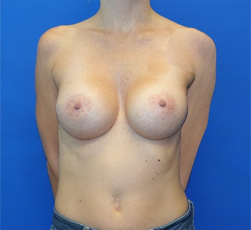 Said Plastic Surgery breast augmentation after — Seattle, WA