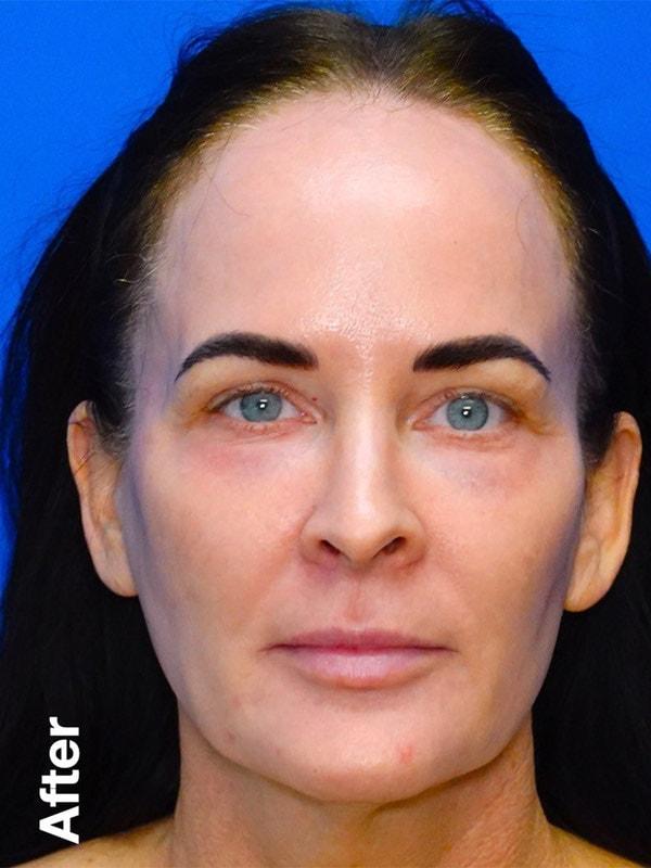 Said Plastic Surgery chemical peel after — Seattle, WA
