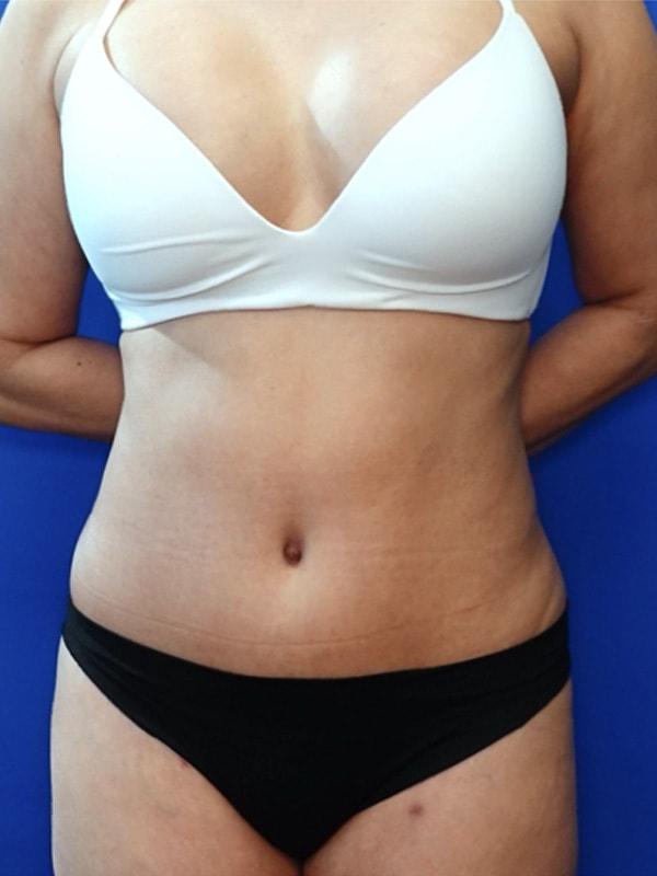 Mini Tummy Tuck after at Said Plastic Surgery in Seattle, WA