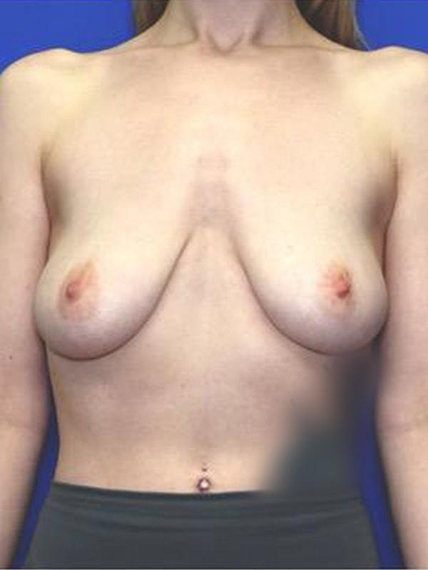 Breast Augmentation before at Said Plastic Surgery in Seattle, WA