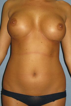 Liposuction before at Plastic Surgery Specialists in Greenbrae, CA