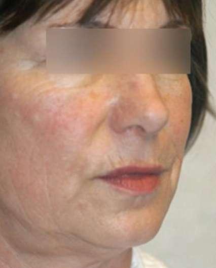 Plastic Surgery Specialists after — Greenbrae, CA