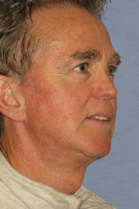 Facelift after at Plastic Surgery Specialists in Greenbrae, CA