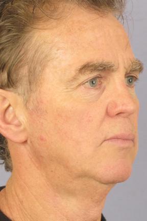 Facelift before at Plastic Surgery Specialists in Greenbrae, CA