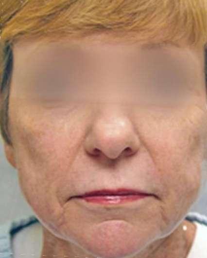 Plastic Surgery Specialists after — Greenbrae, CA