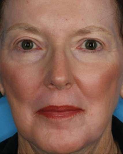 Plastic Surgery Specialists after — Greenbrae, CA