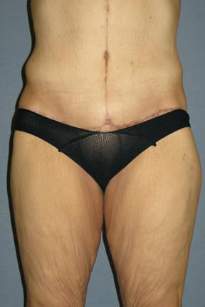 Tummy Tuck after at Plastic Surgery Specialists in Greenbrae, CA