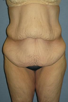 Tummy Tuck before at Plastic Surgery Specialists in Greenbrae, CA