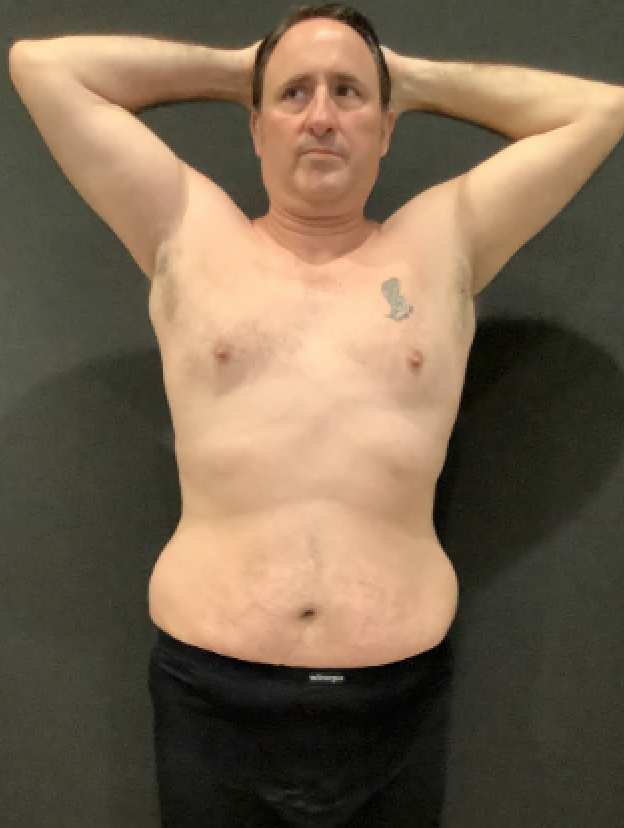Gynecomastia Surgery after at Plastic Surgery Specialists in Greenbrae, CA
