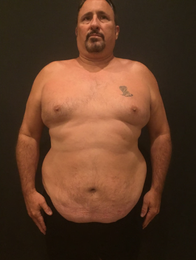 Gynecomastia Surgery before at Plastic Surgery Specialists in Greenbrae, CA
