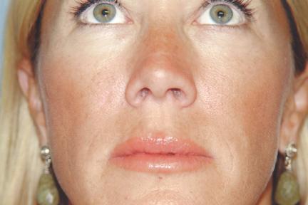 Plastic Surgery Specialists after — Greenbrae, CA