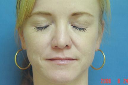 Plastic Surgery Specialists after — Greenbrae, CA