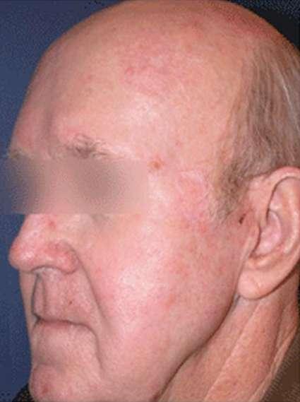 Plastic Surgery Specialists after — Greenbrae, CA