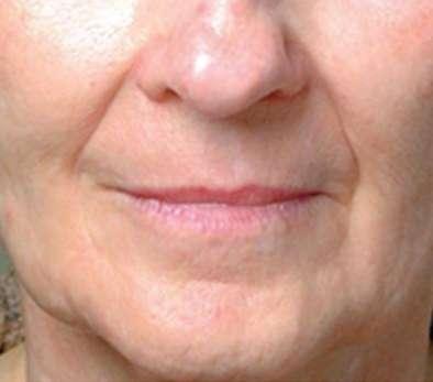 Plastic Surgery Specialists after — Greenbrae, CA