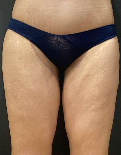 Thigh Lift after at Plastic Surgery Specialists in Greenbrae, CA