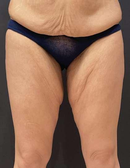 Thigh Lift before at Plastic Surgery Specialists in Greenbrae, CA