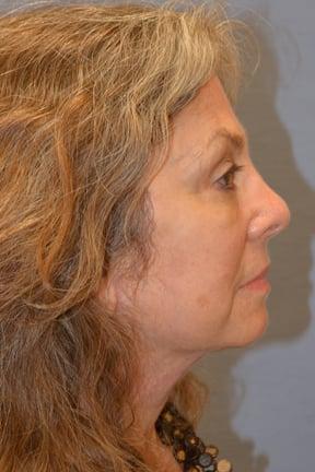 Plastic Surgery Specialists facelift after — Greenbrae, CA