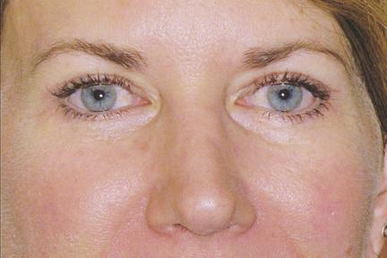 Blepharoplasty after at Plastic Surgery Specialists in Greenbrae, CA