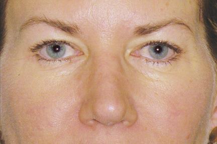 Blepharoplasty before at Plastic Surgery Specialists in Greenbrae, CA