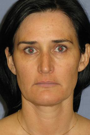 Fat Transfer before at Plastic Surgery Specialists in Greenbrae, CA