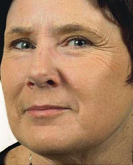 Plastic Surgery Specialists after — Greenbrae, CA