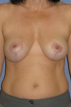 Breast Lift after at Plastic Surgery Specialists in Greenbrae, CA