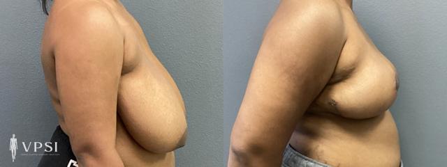 Breast Reduction result at Vegas Plastic Surgery Institute in Las Vegas, NV