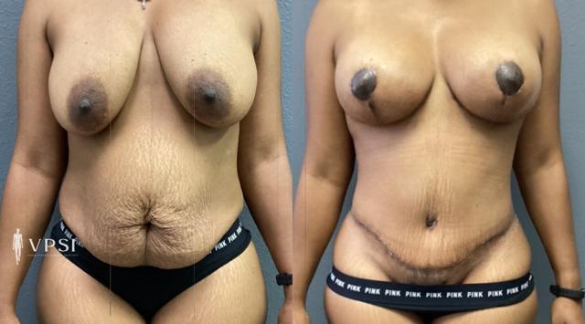 Mommy Makeover result at Vegas Plastic Surgery Institute in Las Vegas, NV