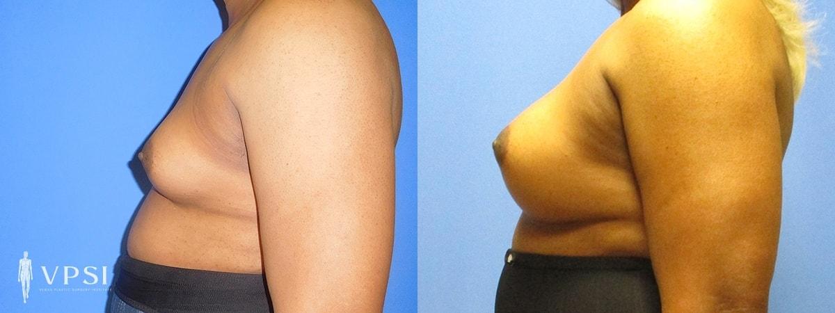 Vegas Plastic Surgery Institute gender affirming top surgery result — Las Vegas, NV