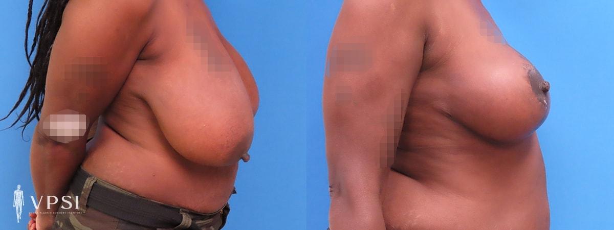 Vegas Plastic Surgery Institute breast reduction result — Las Vegas, NV
