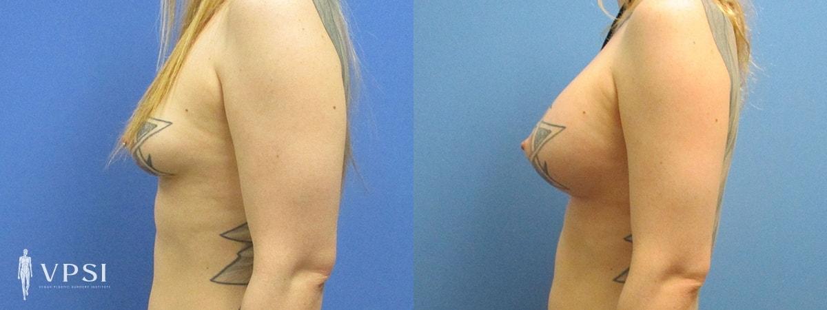 Vegas Plastic Surgery Institute gender affirming top surgery result — Las Vegas, NV