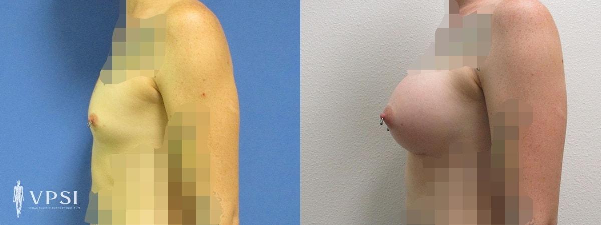 Vegas Plastic Surgery Institute gender affirming top surgery result — Las Vegas, NV