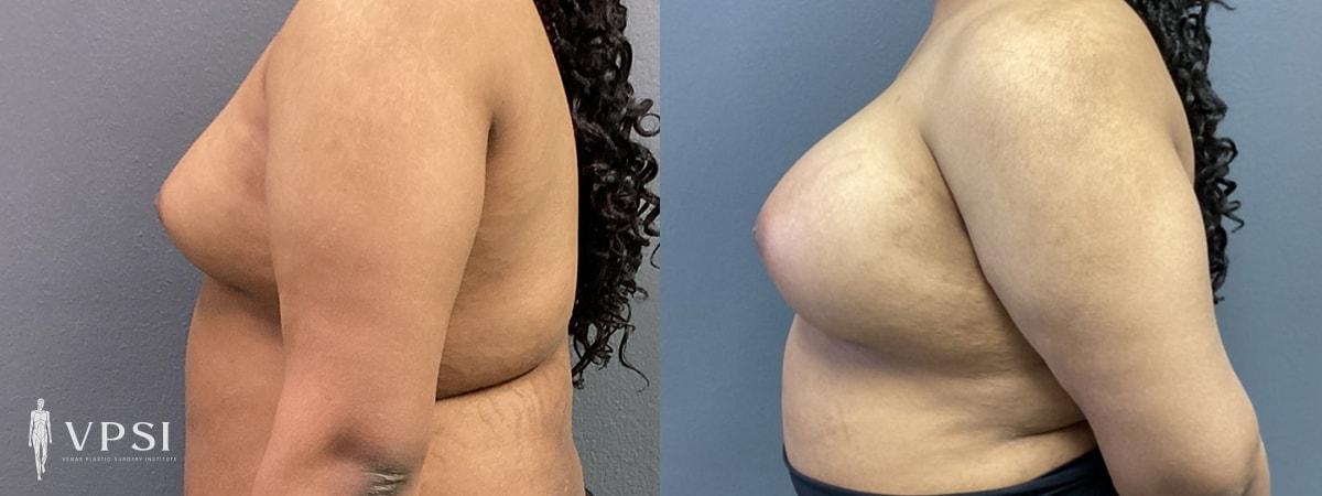 Vegas Plastic Surgery Institute gender affirming top surgery result — Las Vegas, NV