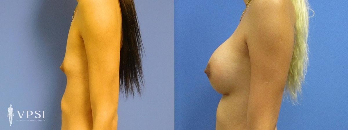Vegas Plastic Surgery Institute gender affirming top surgery result — Las Vegas, NV