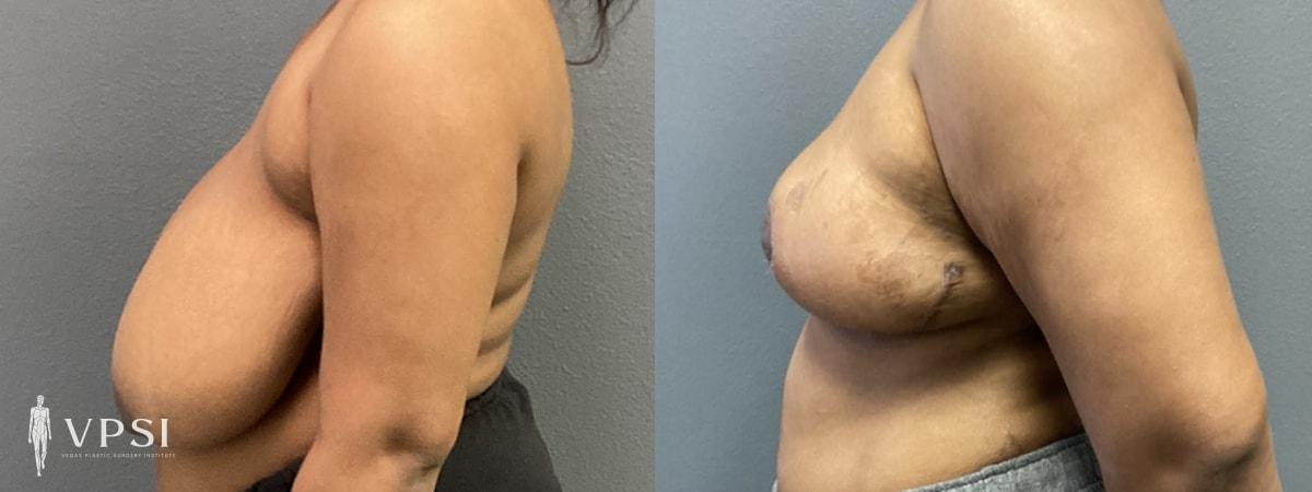 Vegas Plastic Surgery Institute breast reduction result — Las Vegas, NV