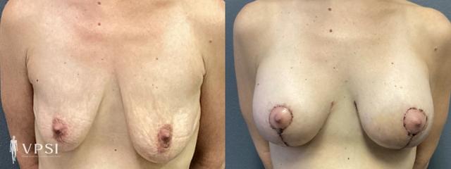 Breast Lift result at Vegas Plastic Surgery Institute in Las Vegas, NV