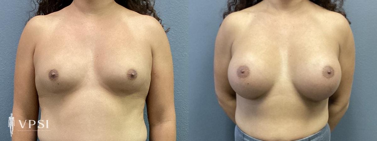 Vegas Plastic Surgery Institute gender affirming top surgery result — Las Vegas, NV