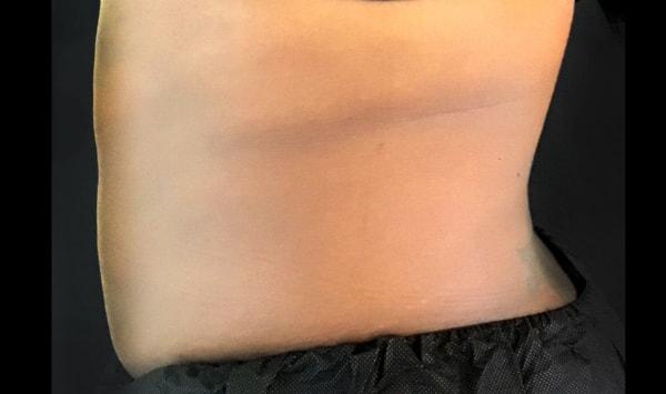 Arm Lift after at Dermatology & Laser of Alabama in Birmingham, AL