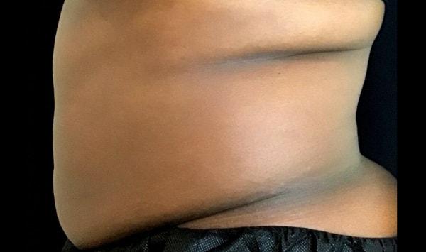 Arm Lift before at Dermatology & Laser of Alabama in Birmingham, AL