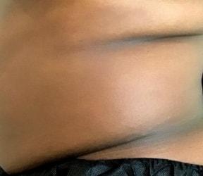 Arm Lift before at Dermatology & Laser of Alabama in Birmingham, AL