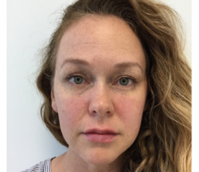 Dermatology & Laser of Alabama after — Birmingham, AL